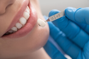 Dental Veeners